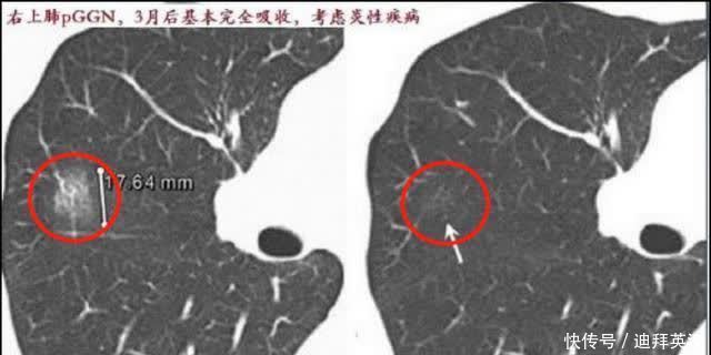 1年看上万张片子的医生透露：如何判断肺结节是不是肺癌？