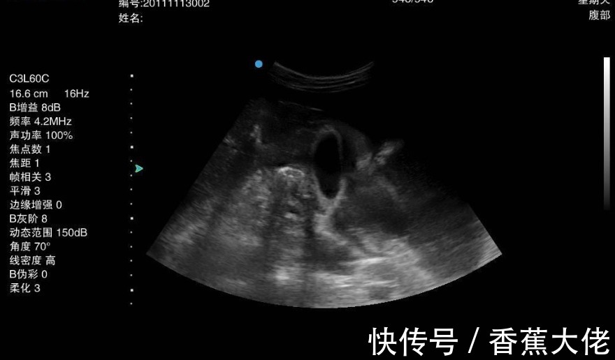 小金|一天一个鸡蛋，26岁快递员患上胃癌，医生：这种“鸡蛋”怎能常吃