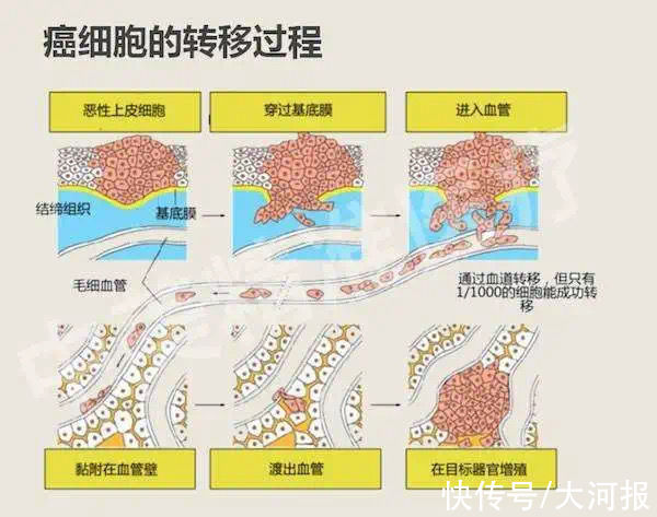 孙国绍|癌症骨转移=没救了？错！记者揭秘河南首家骨转移肿瘤门诊