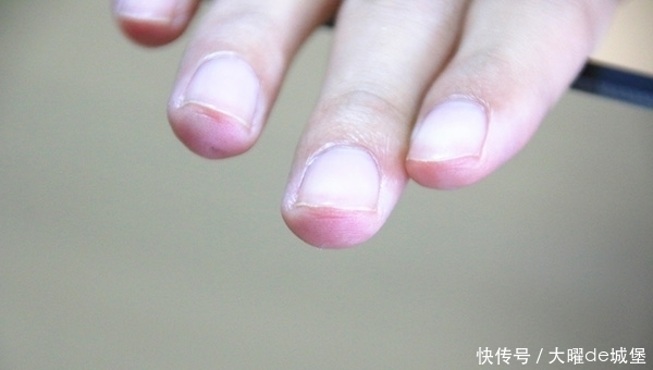 为什么有些人手指甲上有月牙,有些人没有?是怎么回事?