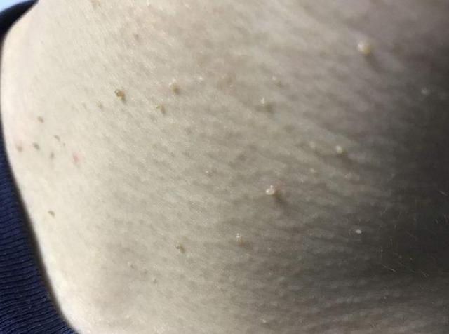 脖子|28岁女子脖子长“肉条”,越来越多,医生别抠,是HPV感染