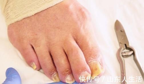 艾叶|脚上老茧不用慌,1个小妙方,助你轻松解决!但4类人并不适宜!