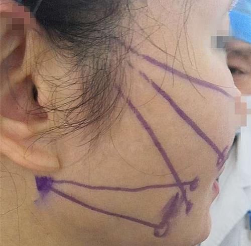 做超微创小切口提升手术，我的顾虑和感受