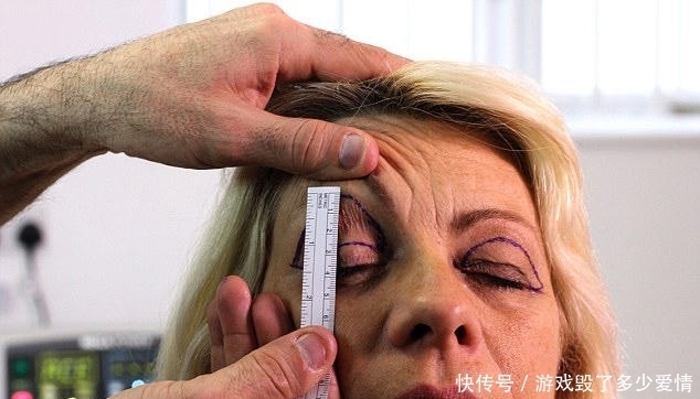 54岁女子贪图便宜，花费2万元在黑市整容，整容后年轻了20岁