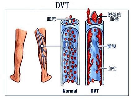 钓鱼“钓出”下肢深静脉血栓？