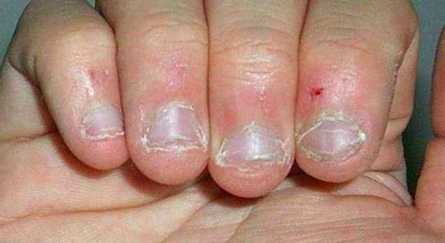 医生|小时候爱啃指甲的娃,长大会怎么样医生直言大概是这两种结局