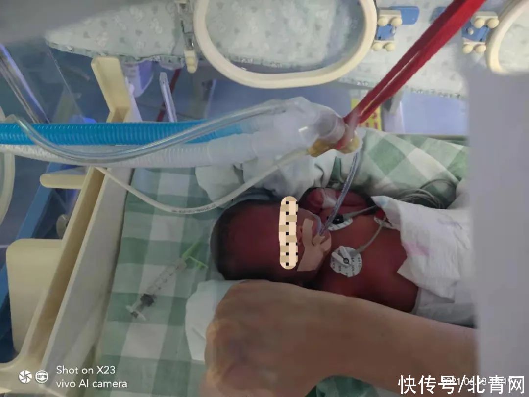 早产|在封闭区产房，三分钟抢回早产儿生命