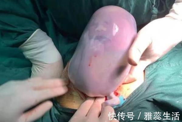 好处|90后产妇生下带壳宝宝,真是独具一格宝宝带膜出生有3大好处