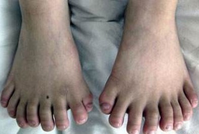 吉尼斯世界纪录|小孩指头竟有34个，打破了吉尼斯世界纪录