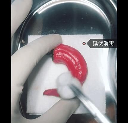 手术|给火龙果割阑尾33岁水果医生爆红吸粉90万网友看到第一个就痛了