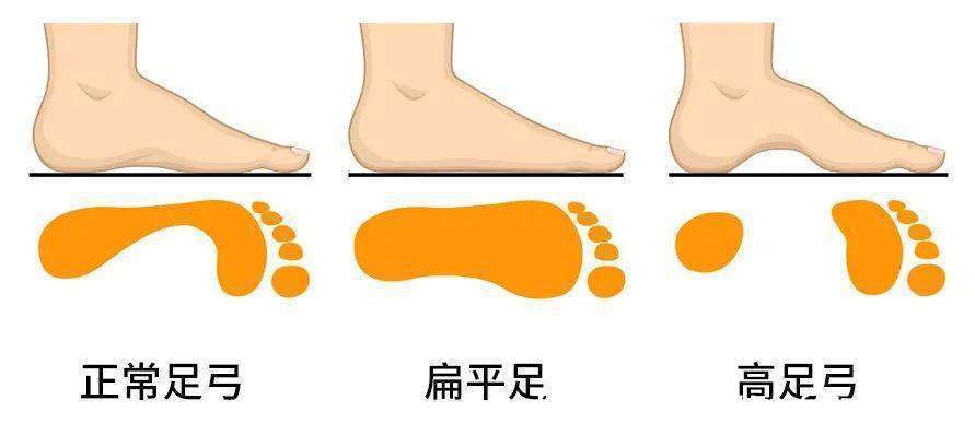 扁平足|女人有没有衰老,看脚部这4种衰老信号,但愿你没有