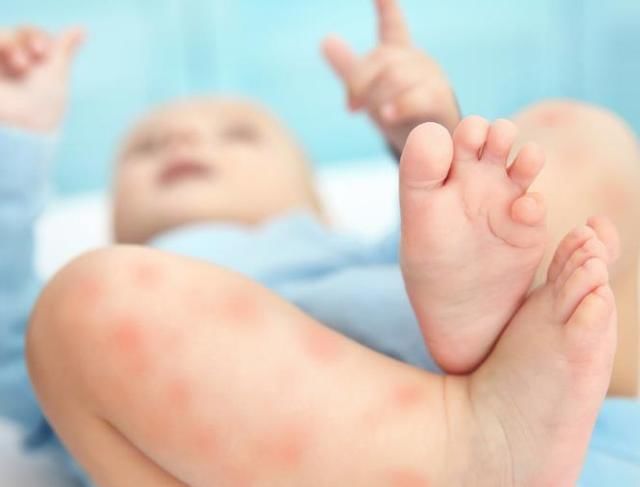 湿疹|宝宝湿疹的3个治疗误区，别再走“弯路”了！