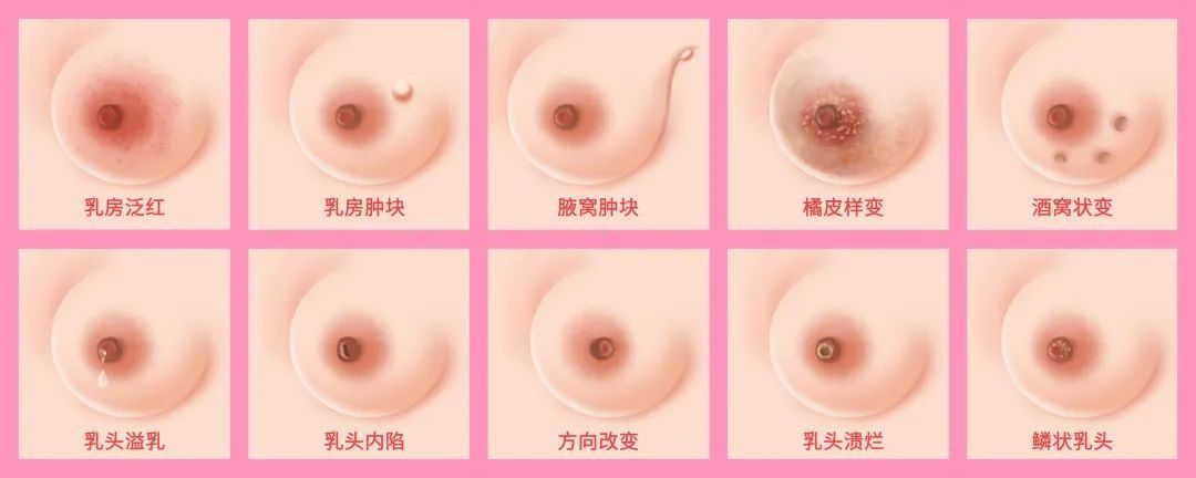 乳房|乳腺结节离癌有多远？