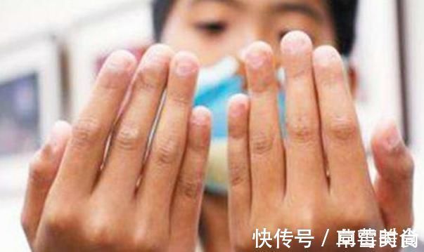 手指甲|孩子爱啃手指甲是病时间长了得抑郁症家长别再犯傻不注意