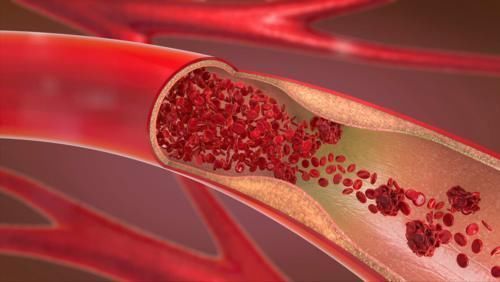 胸腔积液|肺癌最可怕的不是疾病本身,而是伴随的并发症