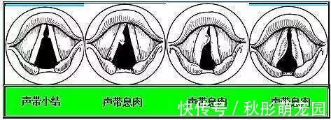 鼻息肉|长大后,它就成了癌!到底要多久?看完这篇,了解息肉的全部