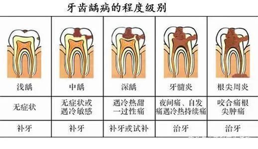 牙髓炎|牙齿反复痛后又不痛了，是自愈了吗？口腔医生告诉你不可能