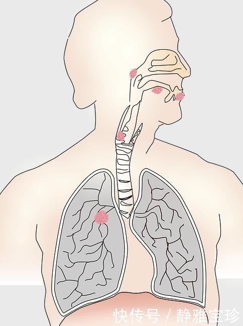 环境生活|体检查出肺部结节,会引发肺癌吗3个答案先让你放心