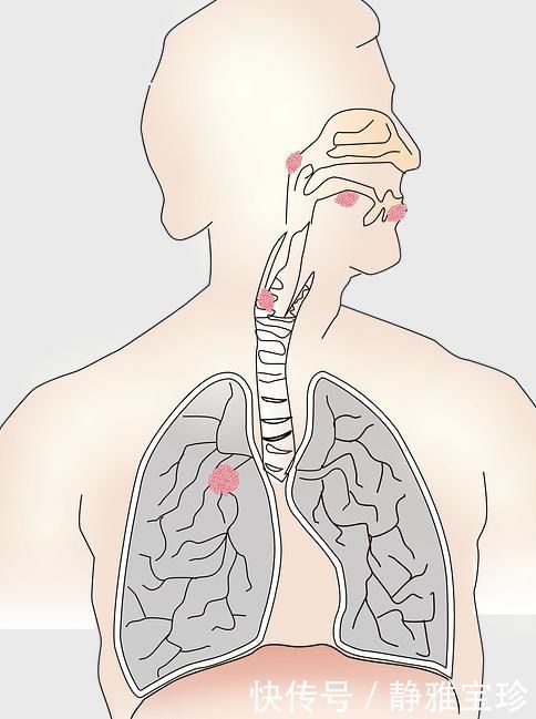 环境生活|体检查出肺部结节，会引发肺癌吗3个答案先让你放心