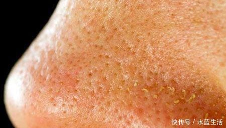 三种现象证明你脸上长了螨虫,还在用醋洗脸吗,难怪没效果