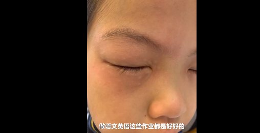 数学题|浙江9岁女孩一做数学题眼睛就过敏，妈妈：做其他科目都没有反应