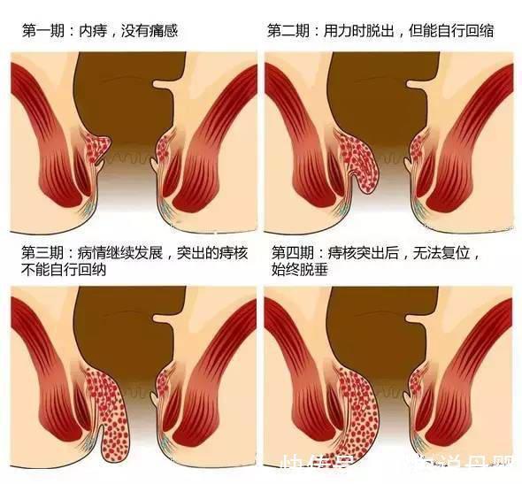 便血|痔疮的症状表现有哪些?缓解痔疮问题,这两步就行!