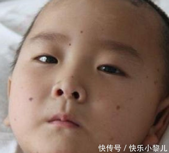 嘴角|宝宝脸上这几个部位有“痣”，父母先别着急点掉，越长大越美