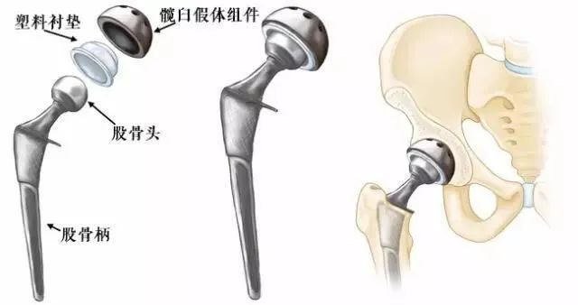阿太|这种骨折，死亡率高达50%！保守治疗还是手术？95岁阿太亲身经历……