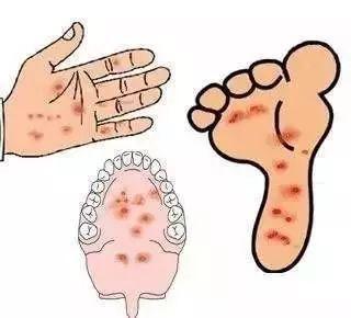 咳嗽|手足口病你真的了解吗专家建议宝妈从3方面发现,做好4预防