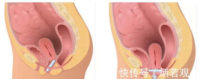 压力性|产后这些「羞耻」的后遗症，折磨了无数宝妈！3招就能解决