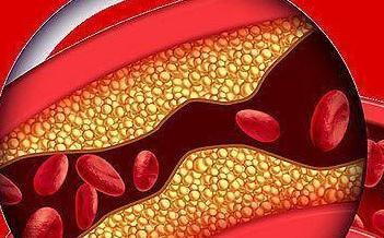 血脂|长了颈动脉斑块,以前吃肉多血脂也高,改成吃素能消除斑块吗?