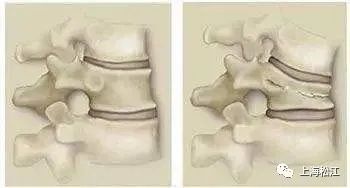 治疗|你了解脊椎压缩性骨折吗？如何治疗？松江医生来解答