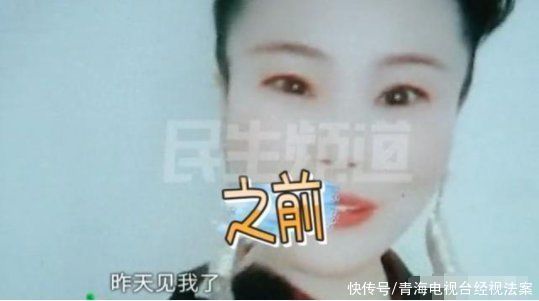 整形|女子花1万多做整形，术后眼睛不对称，崩溃从万人迷变成了妖怪