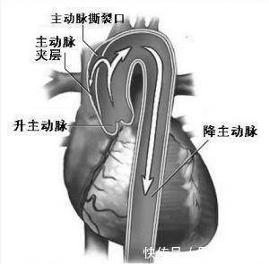 主动脉|54岁“麻将迷”强忍胸痛,就为看了胡一把,结果真“胡”了!