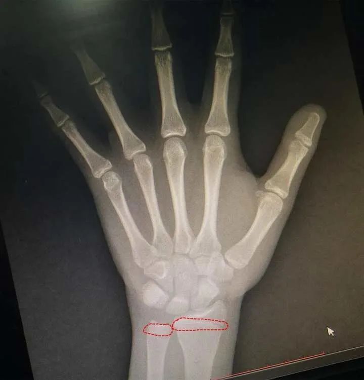 儿子|1米6就不长了!妈妈悔惨:儿子才13岁,6岁弟弟的情况更糟