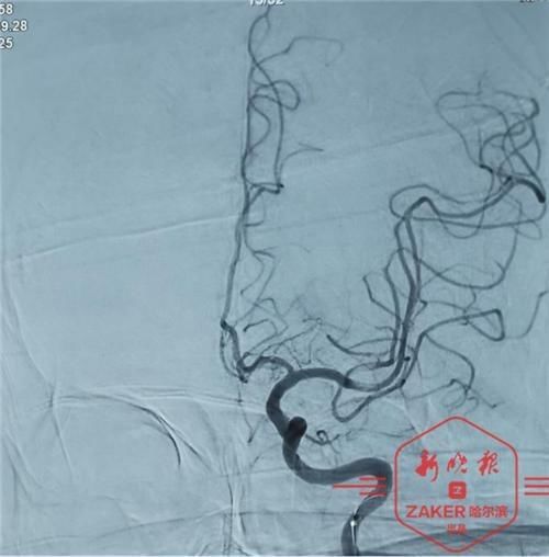 动脉|早起时突发脑梗险致命，哈医大四院多学科联动为患者脑动脉闭塞取栓治疗