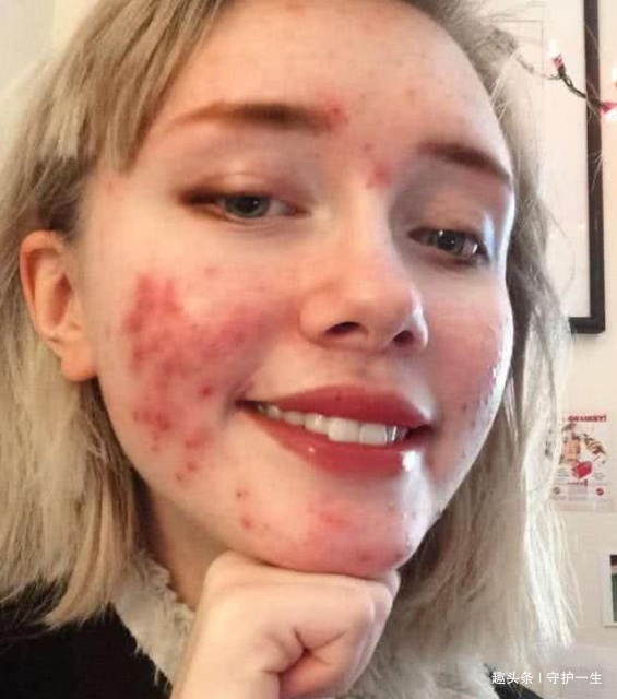 妇科疾病|子宫“脏兮兮”的女孩,脸上会有“3异常”,若一个未中,恭喜咯