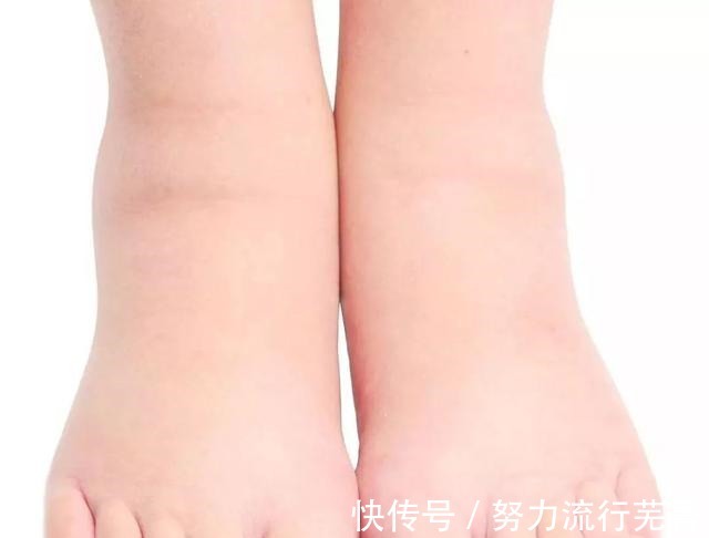 含有|痛风的人越来越多,可能与这五种食物有关!