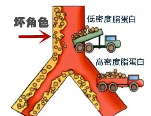 医生|动脉粥样硬化有何危害？是否真的能够被逆转？听听医生怎么说