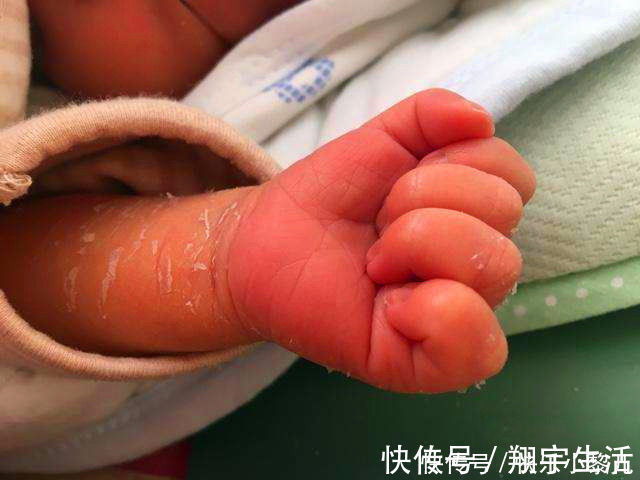 宝宝|新生儿双脚大面积蜕皮，宝妈火急火燎跑医院，医生看到却很淡定