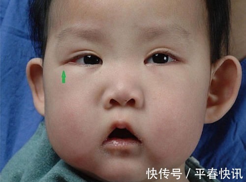 艺伎|宝宝长得太漂亮也是一种病?“歌舞伎综合征”到底是个什么鬼