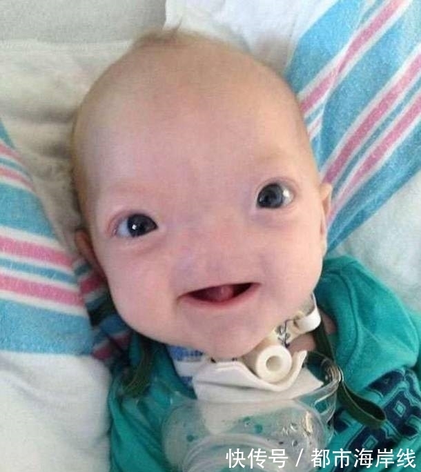 长大|婴儿出生就没有鼻子,父母觉得很可爱,孩子长大后再决定是否手术