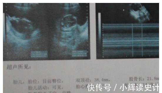 孕检|孕妈孕检时,若怀的是男宝,多数会有这种孕检结果,快来自测一下