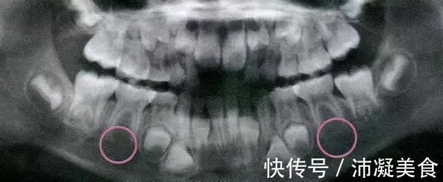 孩子|7岁孩子门牙掉了1年，一直长不出来，家长着急，该怎么办？