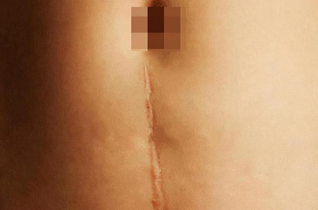产科医生|剖腹产选择“横切”还是“竖切”?别轻视这一刀,两者效果大不同