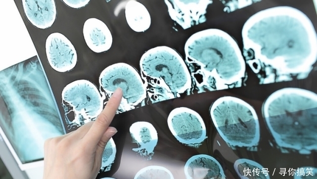 为何脑梗越来越多?医生提醒:早上这一“恶习”,50岁之前赶紧改