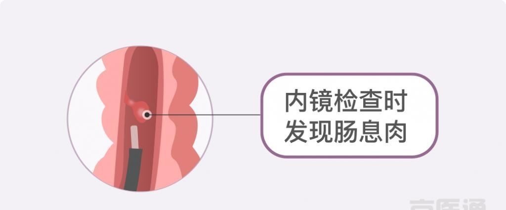 卵巢囊肿|结节、息肉、囊肿是癌症先兆吗?北肿专家们说出了真相!