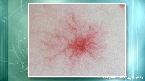 蜘蛛痣|转氨酶为何会升高？提醒：不想肝病找上门， 3种食物要少吃