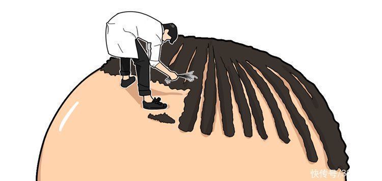 移植|揭秘植发全过程:一次植发能维持多久?哪些人不适合做?有多贵?