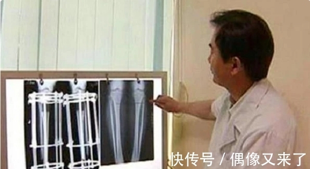 落选|因身高过低自卑,花16万断骨增高7.2厘米的李亚诺,后来怎样了?